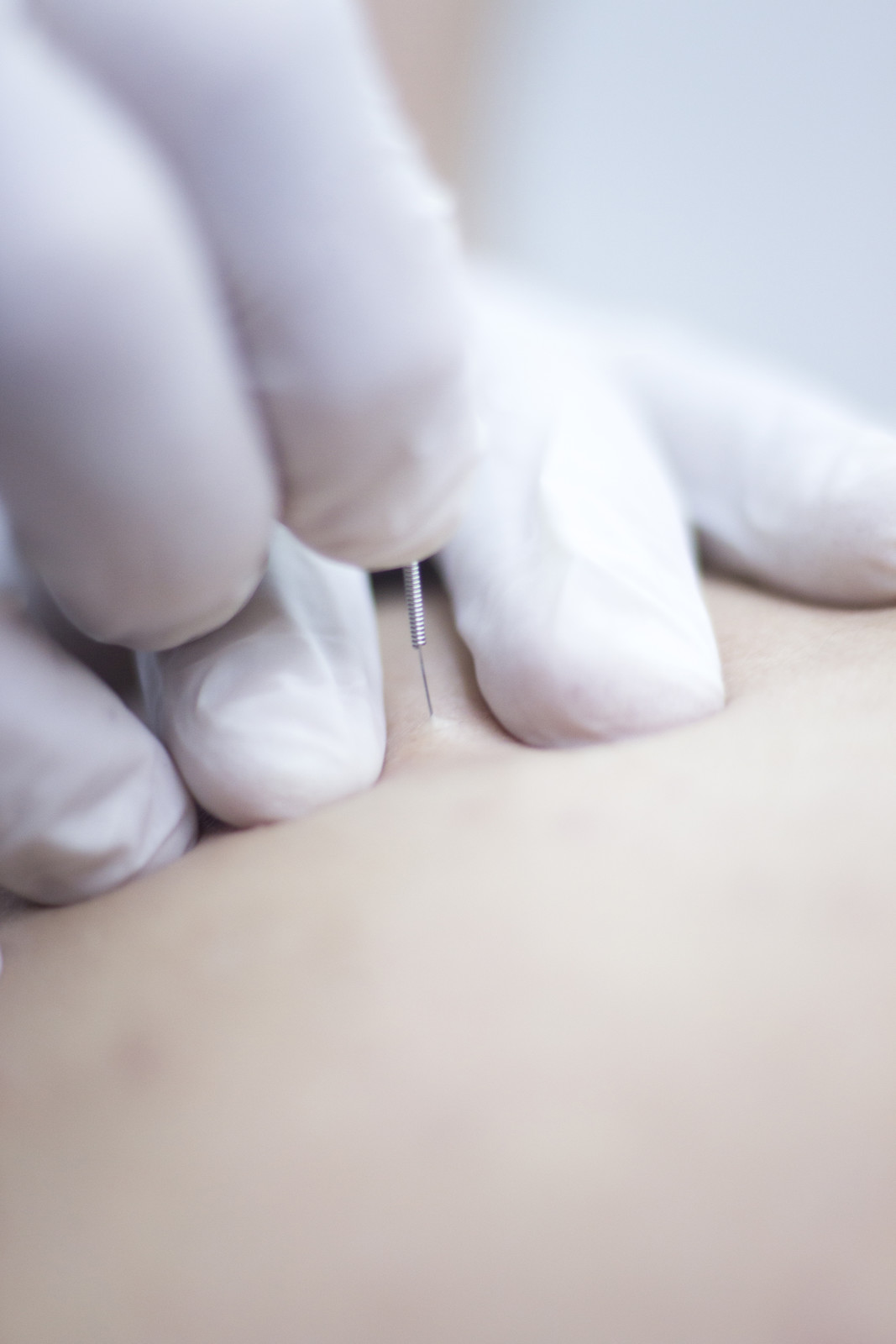 Dry needling trigger point therapy