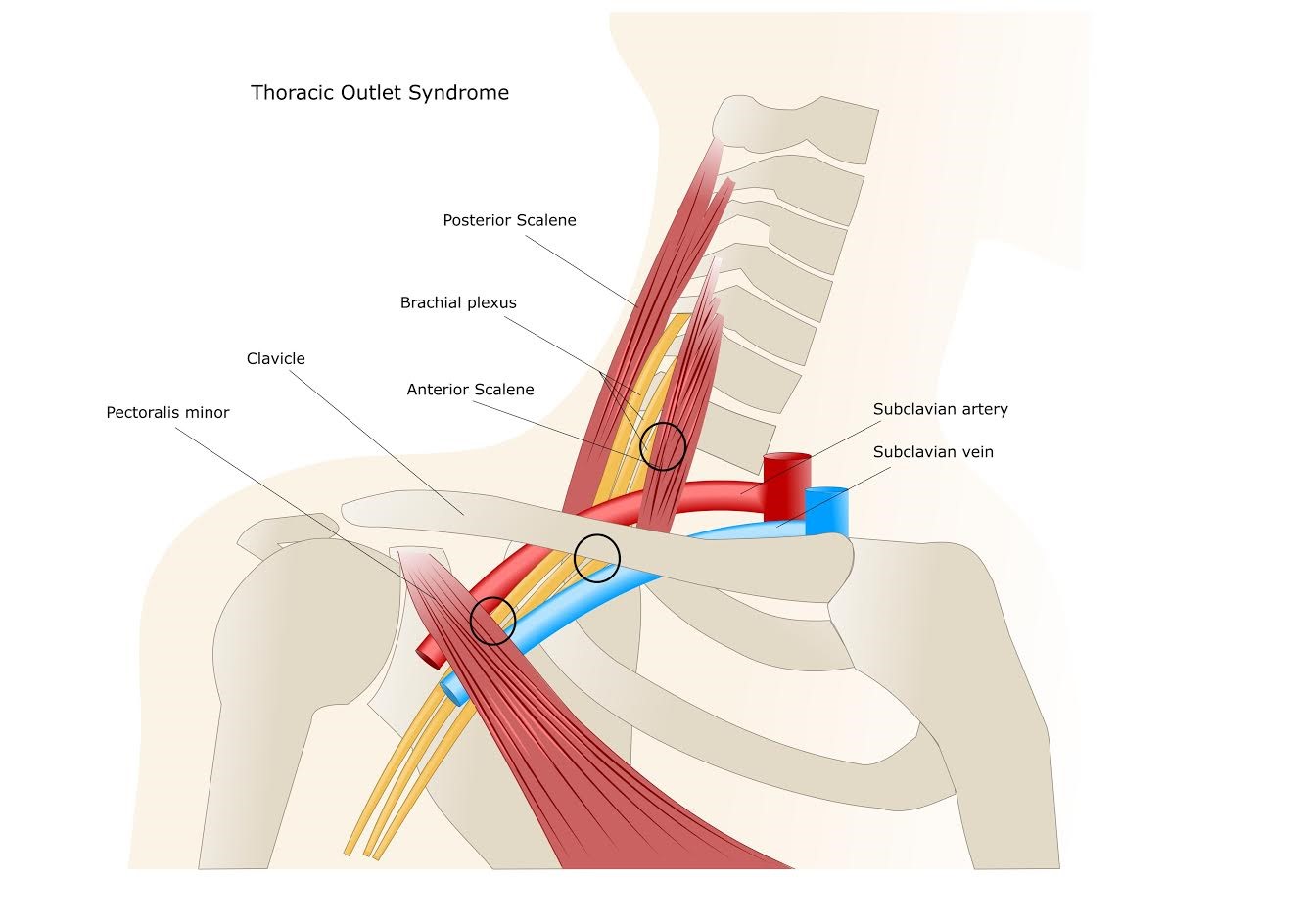 Understanding thoracic outlet syndrome symptoms and treatment